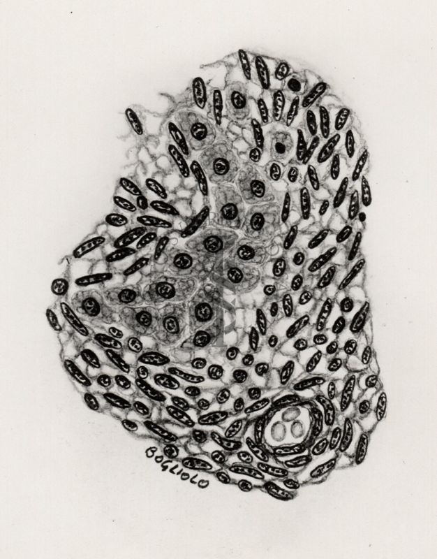 Sarcoma epatico da Cystocercus fasciolaris, isola di cellule normali in tessuto blastomatoso.