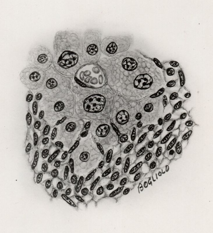 Limiti tra zone sane e zona sarcomatosa (Sarcoma da Cysticercus fascicolaris)