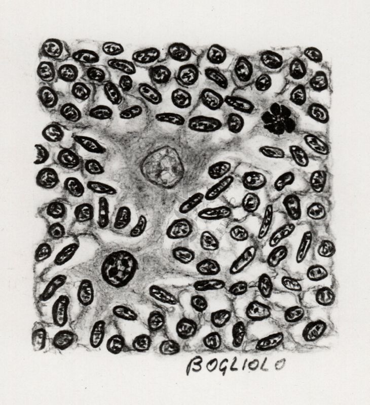 Sarcoma da cisticercus fasciolaris