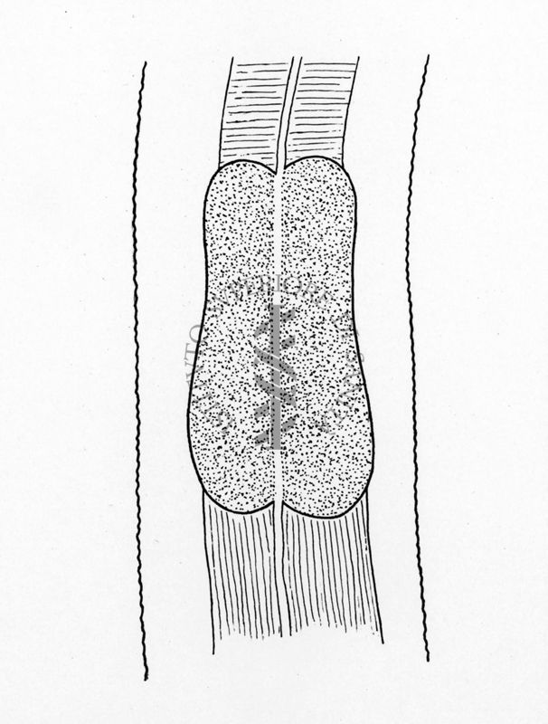 Agamocheilida capsularia. Bullo esofageo