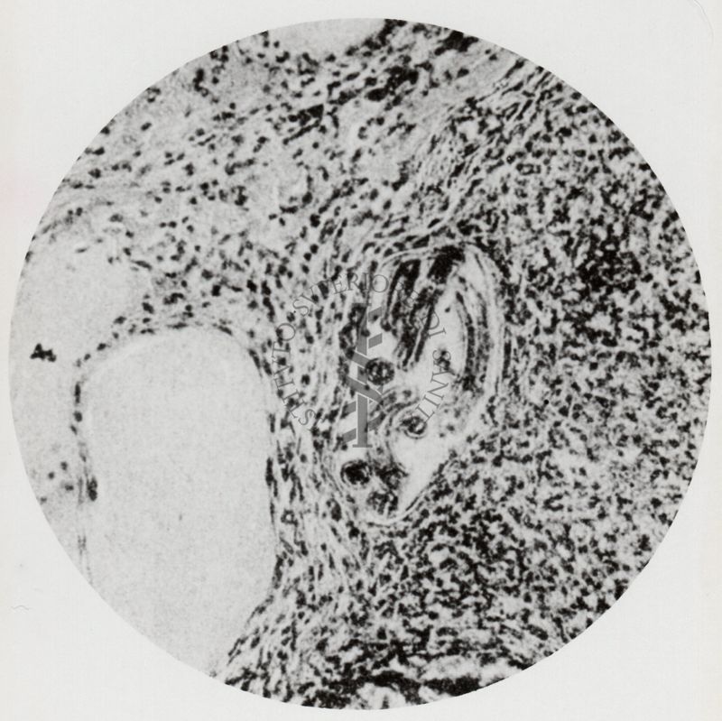 Vaso linfatico peri-ghiandolare ripieno di larve di Anchylostoma