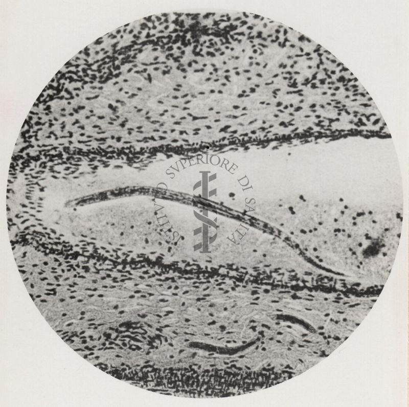 Larva di Anchylostoma in un vaso venoso sottocutaneo