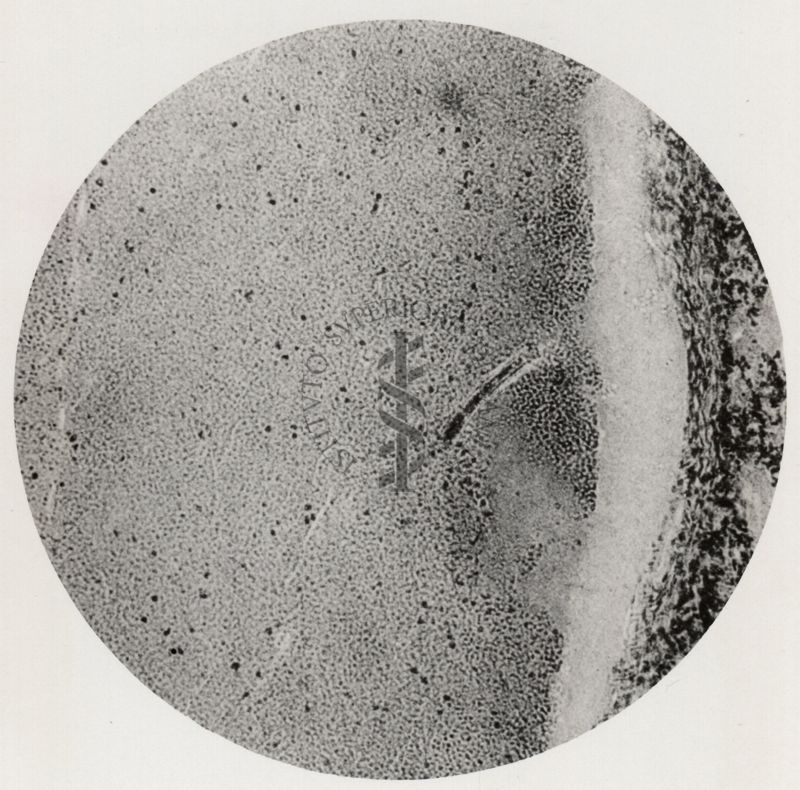 Larva di Anchylostoma in una vena polmonare