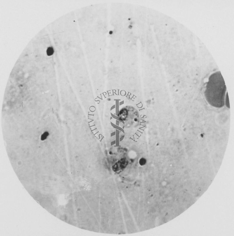 Trypanosoma gambiense - forma a Leishmania nel midollo delle ossa