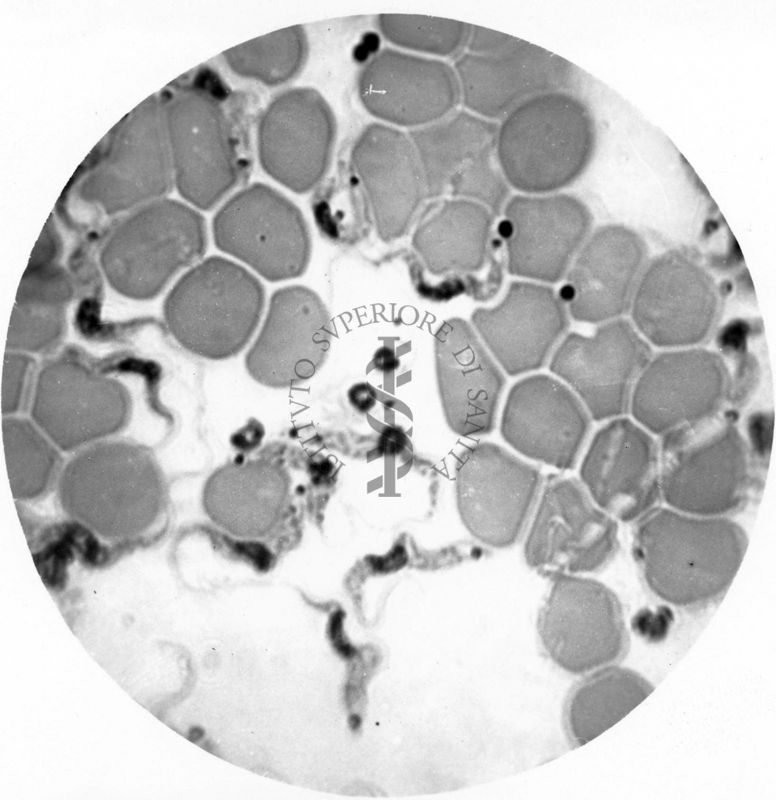 Trypanosoma gambiense - forme a Leishmania nel sangue circolante