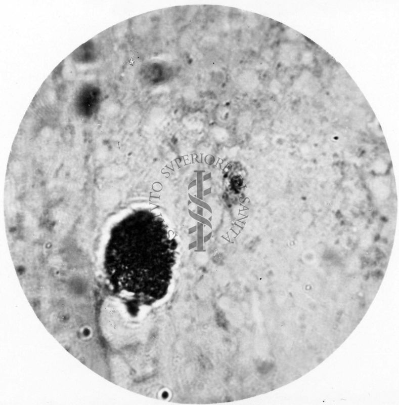 Trypanosoma gambiense - forma a Leishmania in uno striscio di midollo spinale