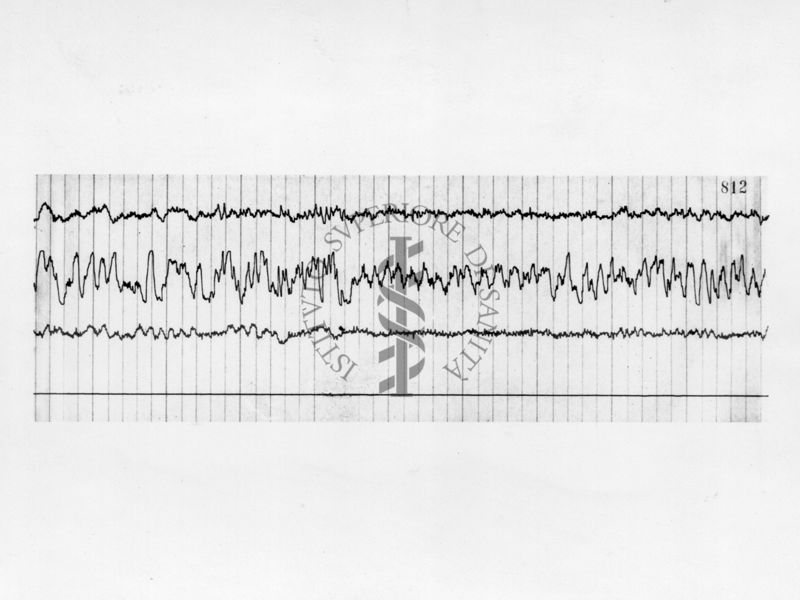 Elettroencefalografici di prove farmacologiche sulla idrazide dell'acido isonicotinico