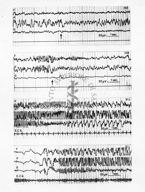 Fotomontaggio delle quattro tavole riguardanti l'Elettroencefalografici di prove farmacologiche sulla idrazide dell'acido isonitinico