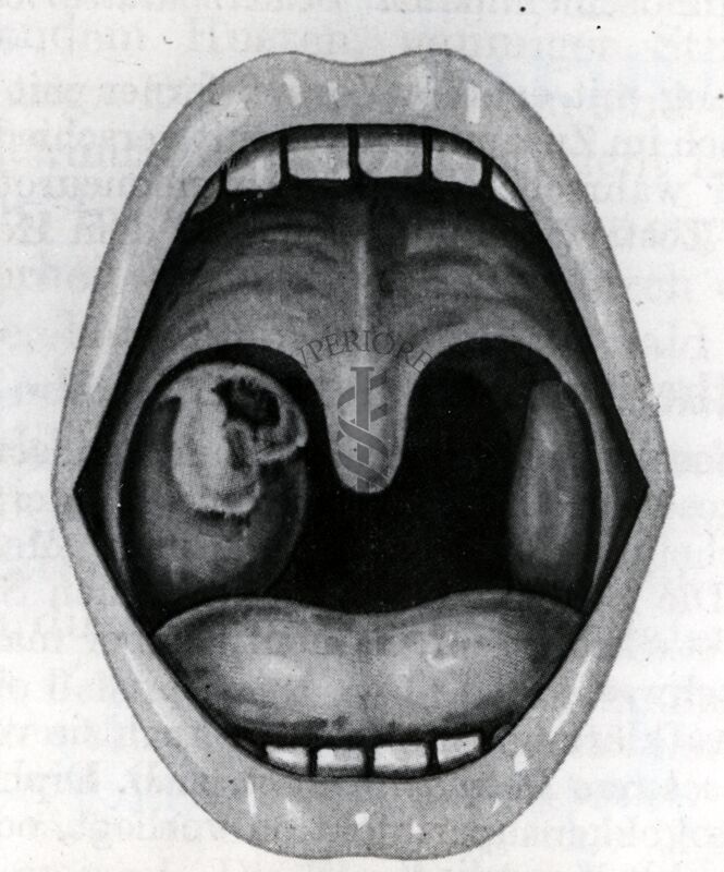 Angina di Plant Vincent - Riproduzione da libro