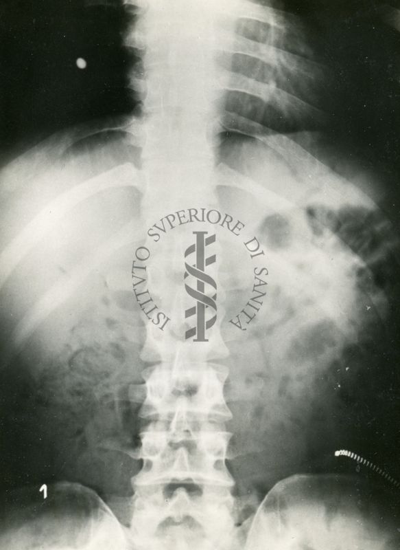 Controllo radiologico del comportamento nell'apparato digerente di compresse opache ai raggi X rivestite con vernici gastro-resistenti