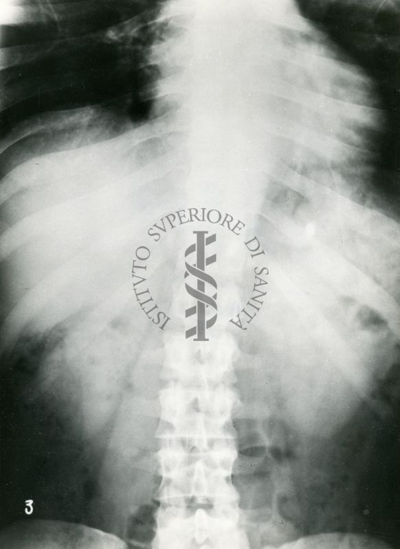 Controllo radiologico del comportamento nell'apparato digerente di compresse opache ai raggi X rivestite con vernici gastro-resistenti