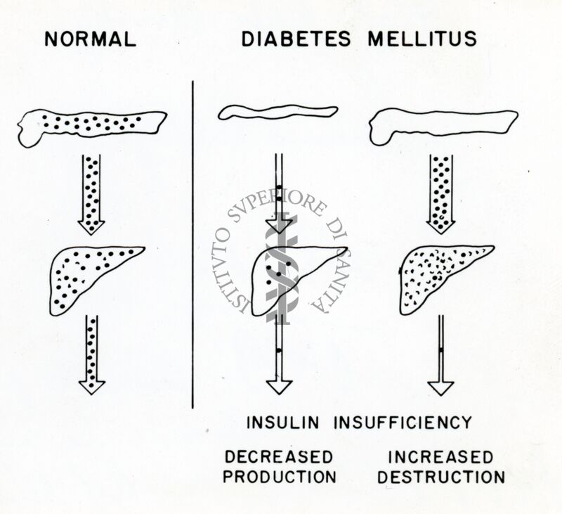 Diagramma sulla insufficienza insulinica nel diabete mellito