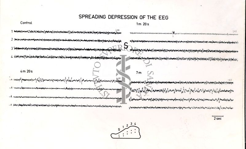 Immagine che ritrae l'andamento dell' EEG