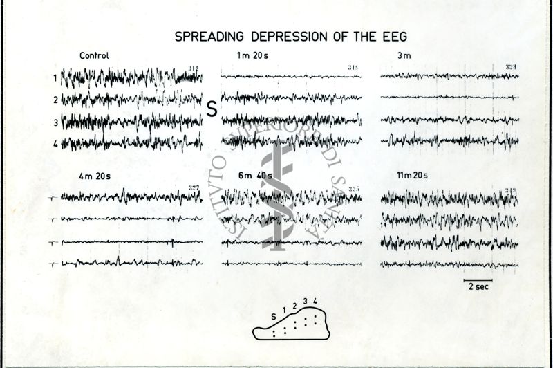 Immagine che ritrae l'andamento dell' EEG