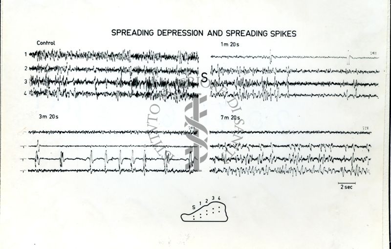 Immagine che ritrae l'andamento dell' EEG