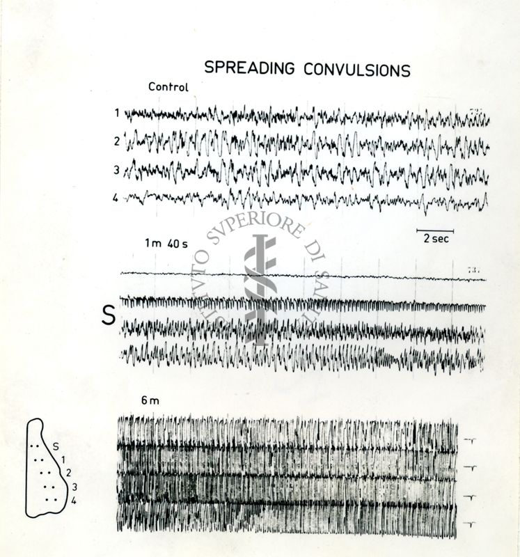 Immagine che ritrae l'andamento dell' EEG