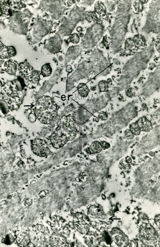 Tessuto muscolare che presenta evidenti degenerazioni strutturali