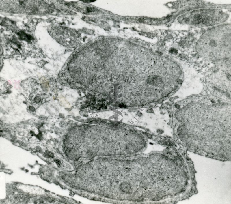 Sezione di tessuto che mostra cellule con nuclei ben conservati e citoplasma alterato