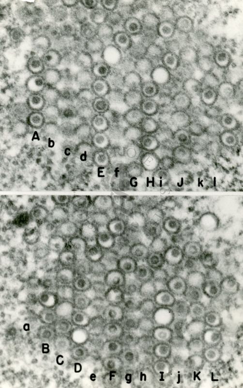 Aggregati di virus erpetici nel citoplasma di una cellula infettata. Alcune particelle appaiono vuote mentre altre contengono un "core" elettrondenso (DNA virale)