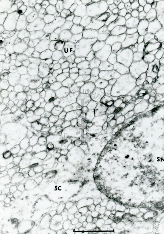 Particolare di una cellula sebacea in cui sono visibili una parte del nucleo ed il citoplasma pieno di gocce lipidiche