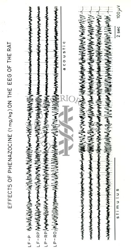 Tracciati elettroencefalografici