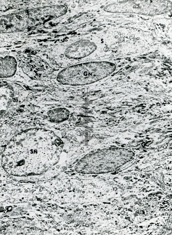 Sezione ultrasottile di un tessuto osservato a basso ingrandimento. Le cellule mostrano nuclei eterogenei