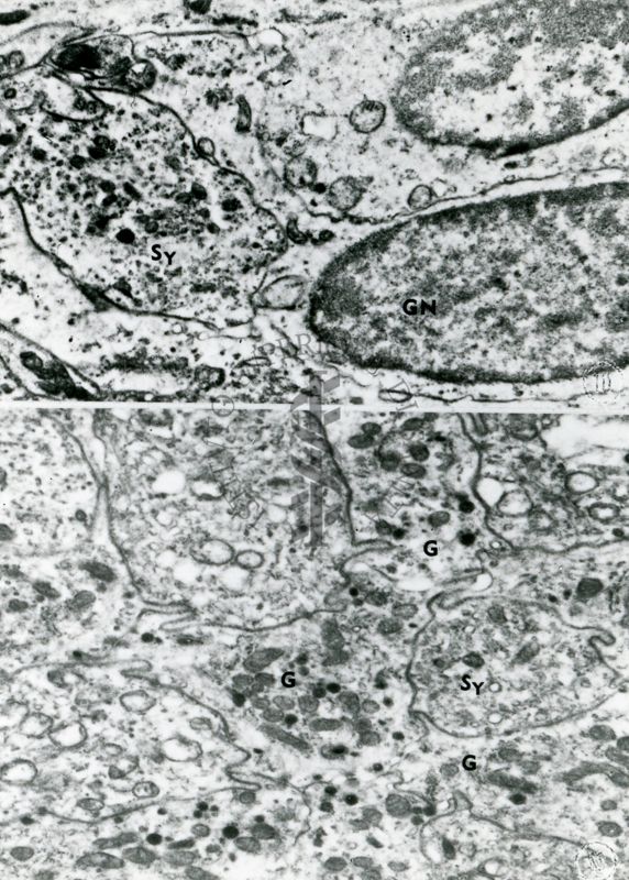 Particolari di nuclei (foto in alto) e porzioni di citoplasma (foto in basso) di un tessuto compatto con cellule molto danneggiate