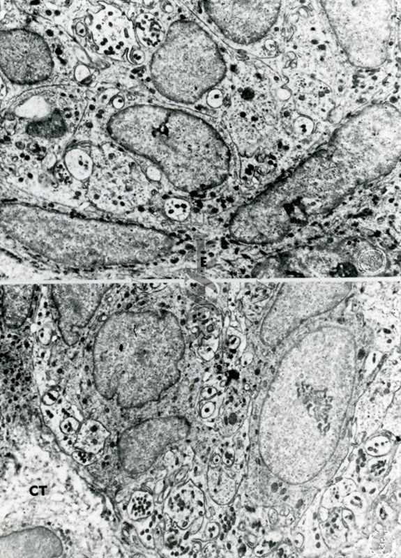 Sezione ultrasottile di tessuto osservata a basso ingrandimento. Le due micrografie mostrano cellule con nuclei eterogenei e numerose inclusioni citoplasmatiche