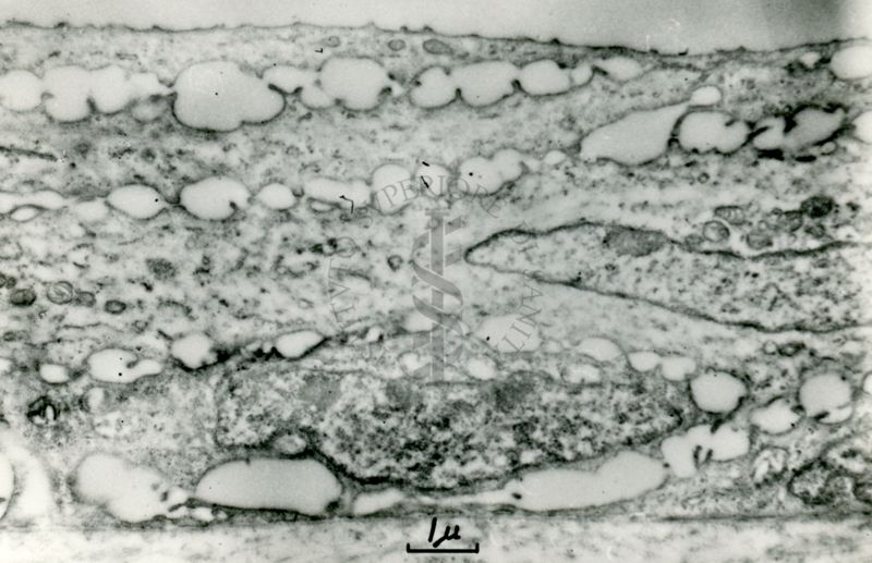 Tessuto stratificato caratterizzato da cellule con nuclei fusiformi e spazi intercellulari vacuolizzati