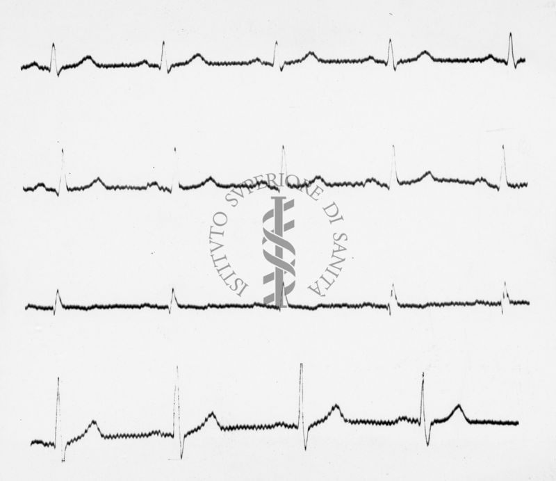 Reperti elettrocardiografici nelle artropatie croniche