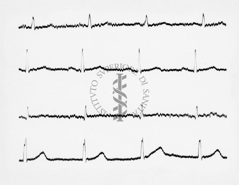 Reperti elettrocardiografici nelle artropatie croniche