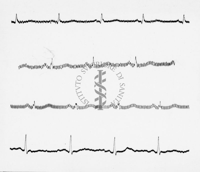 Reperti elettrocardiografici nelle artropatie croniche