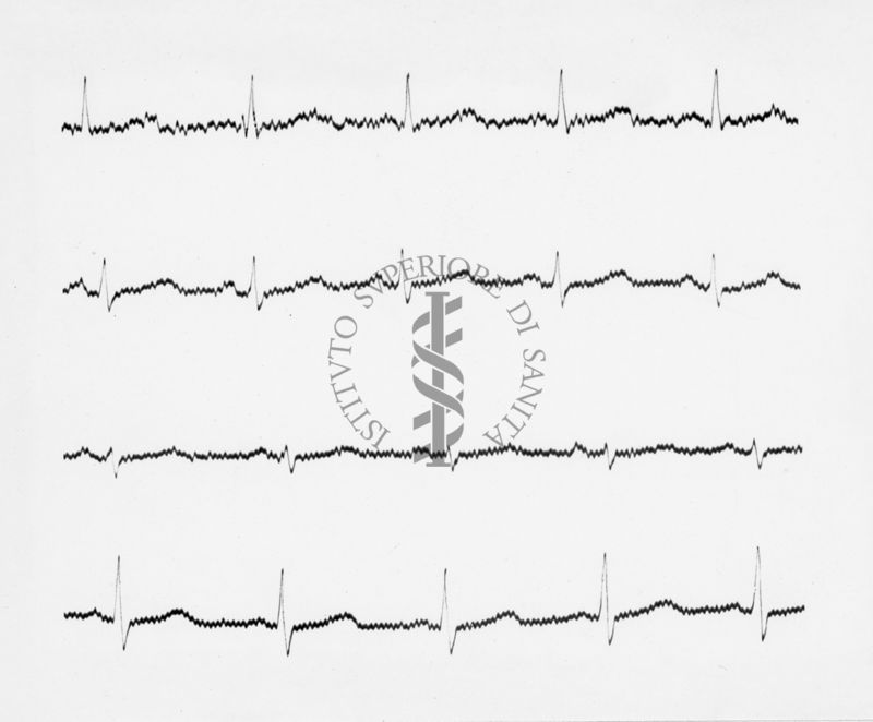 Reperti elettrocardiografici nelle artropatie croniche