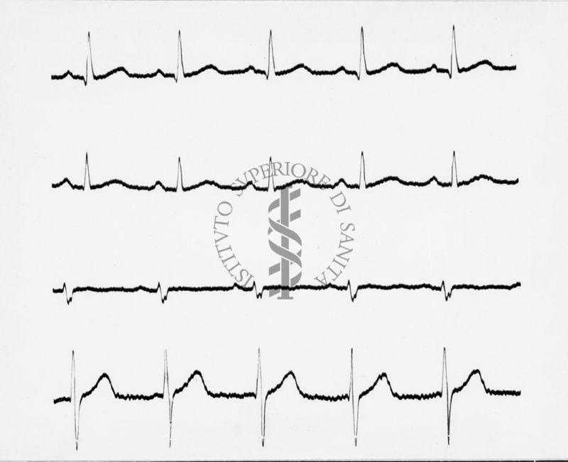 Reperti elettrocardiografici nelle artropatie croniche