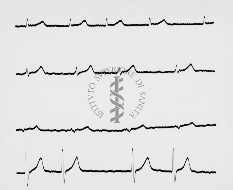 Reperti elettrocardiografici nelle artropatie croniche