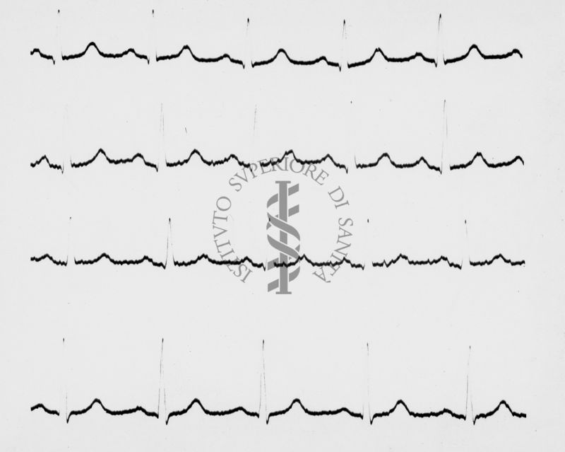 Reperti elettrocardiografici nelle artropatie croniche