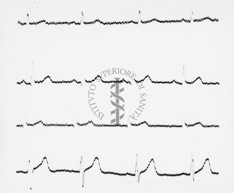 Reperti elettrocardiografici nelle artropatie croniche