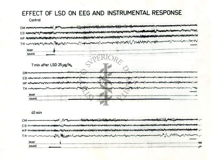 Tracciati EEG sulla risposta al trattamento con LSD