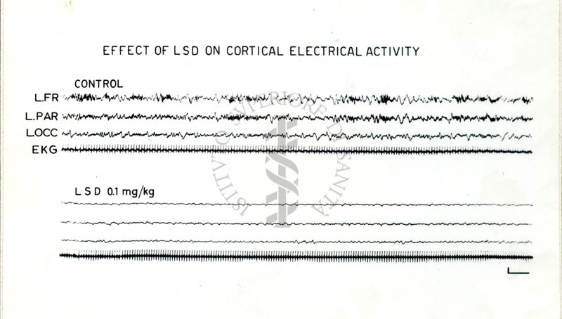 Tracciati EEG: effetti dell'LSD sull'attivazione corticale