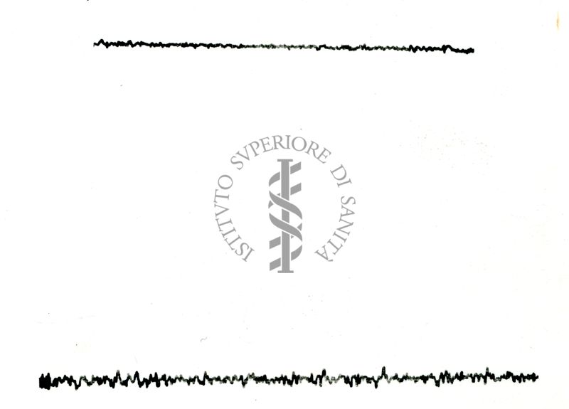 Possibili tracciati EEG