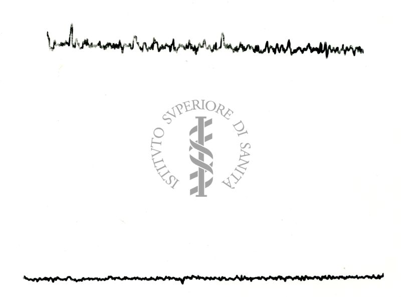 Possibili tracciati EEG