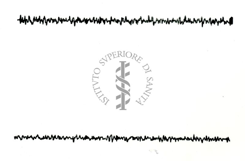 Possibili tracciati EEG