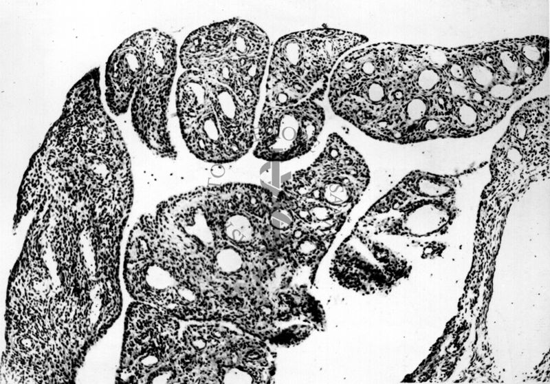 Artrite reumatoide nella lussazione della spalla