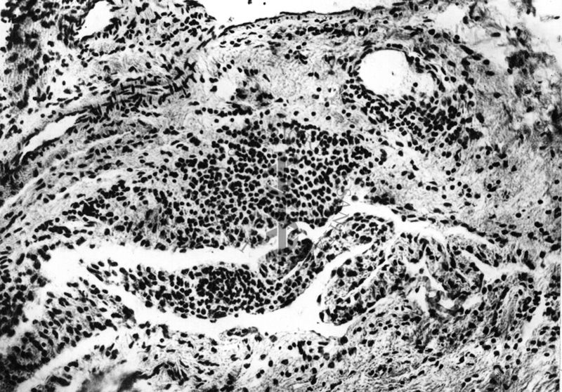 Artrite reumatoide nella lussazione della spalla