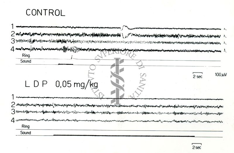 Possibili tracciati EEG