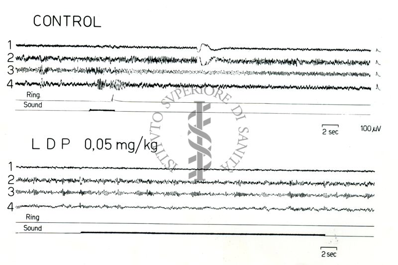 Possibili tracciati EEG