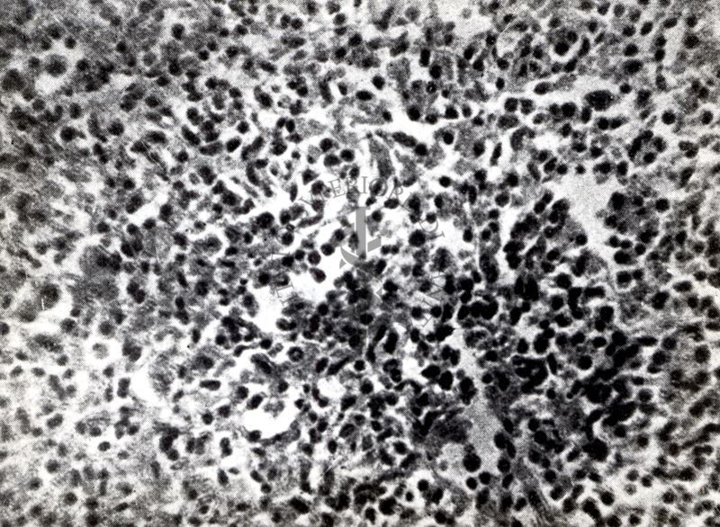 Provocazione sperimentale della flogosi iperergica produttivo-sclerotica (milza)