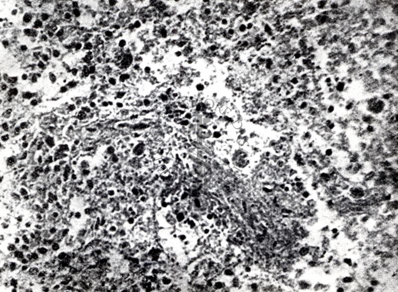 Provocazione sperimentale della flogosi iperergica produttivo-sclerotica (milza)