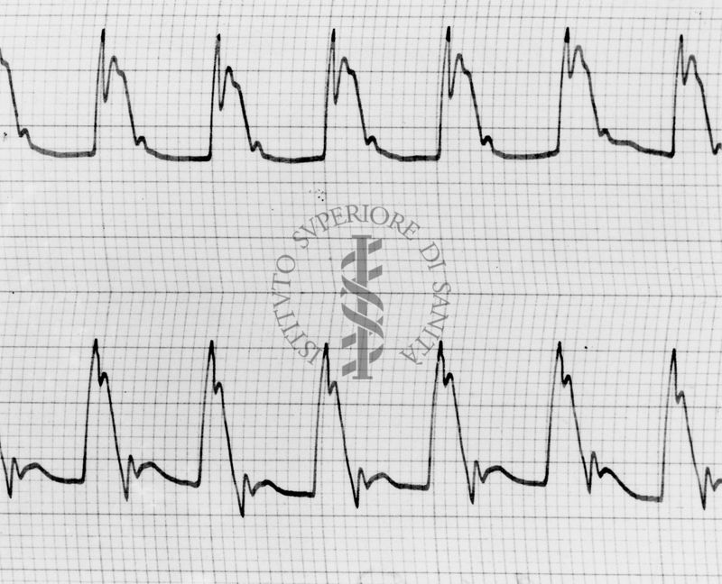 Sfigmogrammi sull'apertura e chiusura dei vasi sanguigni