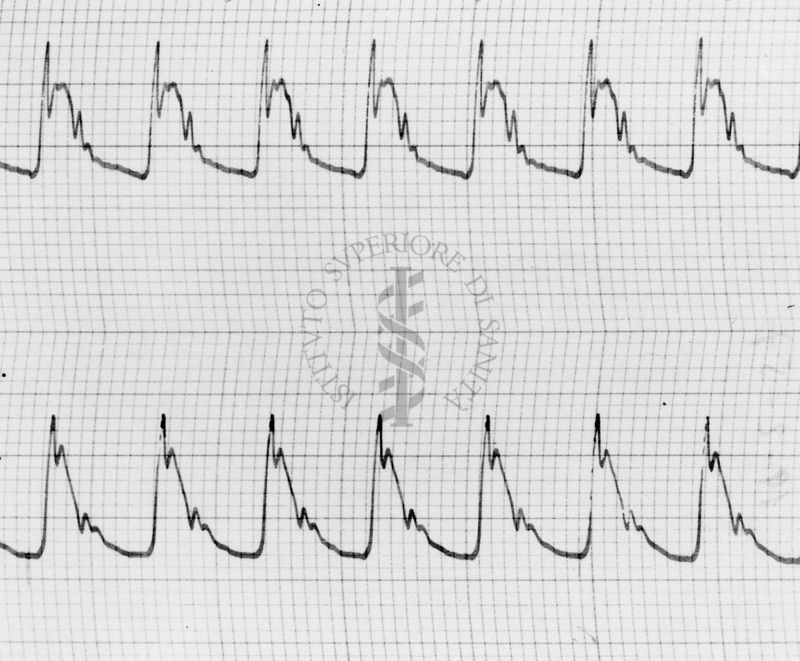 Sfigmogrammi sull'apertura e chiusura dei vasi sanguigni